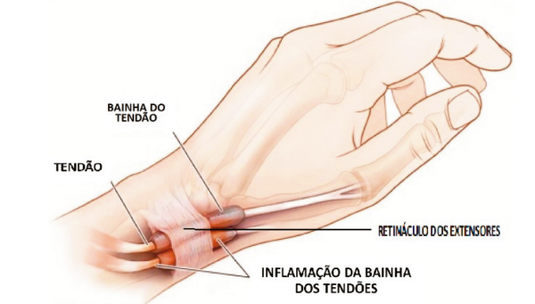 Tendinite da base do polegar - Clínica da Mão